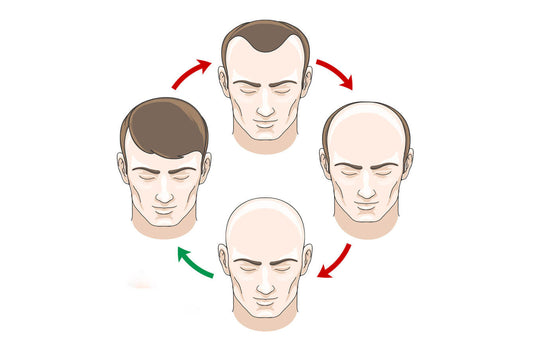 Why Do Men Go Bald - Effective Treatments